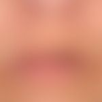 Exogene Ablagerungsdermatose: Argyrose
