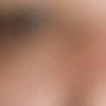 Xanthelasma. 63 Jahre alter Patient mit bekannter Hyperlipidämie. Die bestehende Hautläsion entwi...