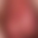 Dermatose benigne chronische bullöse des Kindesalters: pralle transluzente Blasen bei einem 2-Jäh...