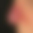 Lupus pernio: 63-year-old female patient with reddish-livid plaque of the nose and previously kno...