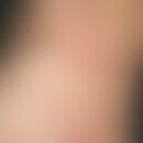 Erythema gyratum repens: Chronisch dynamische (seit mehreren Monaten wechselhafter Verlauf), durc...