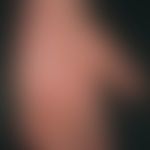 Atopische Dermatitis (Übersicht):  Chronisches atopishes Handekzem. Flächige Rötung der gesamten ...