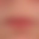 Perlèche: altersgerechte Involution der Lipppen. Deutliche Cheilitis actinica. Diskrete beidseiti...