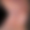 Leukämie akute myeloische: große rot-braune (hämorrhagische), unscharf begrenzte, oberflächenglat...