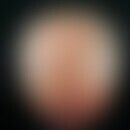 Alopezie, androgenetische: typisches Befallsmuster bei androgenetischer Alopezie.
