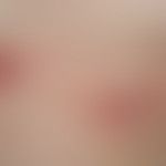 Primary cutaneous marginal zone lymphoma: 10 monthsago , first appearance of red, surface smooth ...