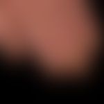 chronic paronychia: existing for months (physiological growth of the fingernail about 0.10 to 0.1...