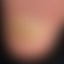 Retronychie: psoriatrische Onychodystrophie, mit weitegehender Zerstörung der Nagelplatte. Seit l...