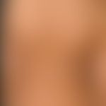 Vitiligo: Multiple predominantly roundish vitiligo foci, encircling a focus with a central remnan...