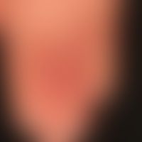Pernio. perniones, painful ... Pernio. perniones, painful frostbite recurring in the cold with known (idiopathic) Raynaud's synd...