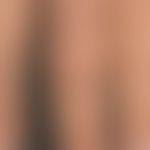 Porphyria cutanea tarda: Detailaufnahme. Ältere Narben durch sterne geknnzeichnet. Vertikale Pfei...
