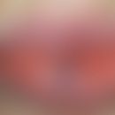 Phlebektasie. Sog. Lippenrandangiom. Harmloser, bläulicher, weicher und exprimierbarer Knoten der...