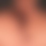 pemphigus vulgaris: recurrent clinical picture for months. superficially, weeping, non-detachable...
