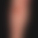 Epidermolysis bullosa acquisita: bulging (subepithelial) blisters of varying size, predominantly ...