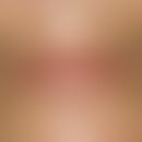 Lentigo simplex: mulitple, scharf begrenzte, hellbraune Pigmentflecken an lichtexponierten Stelle...