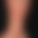 Dermatoliposklerose. 64-jähriger Patientin  mit bekannter CVI. Seit Jahren zunehmende Verhärtung ...