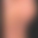 Keratoderma blennorrhagicum: Circinary hyperkeratotic, partly pustular or erosive foci, the prese...