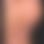 Keratoderma blennorrhagicum: Circinary hyperkeratotic, partly pustular or erosive foci, the prese...