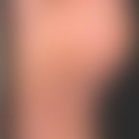 Keratoderma blennorrhagicum... Keratoderma blennorrhagicum: Circinary hyperkeratotic, partly pustular or erosive foci, the prese...