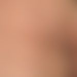 Parapsoriasis en plaques, großherdige: symptomlose, gut begrenzte. disseminierte  Flecken und Pla...
