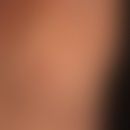 Mondor-Krankheit: plötzlich aufgetretene, strangförmige, etwa 7 cm lange, feste, nur gering schme...