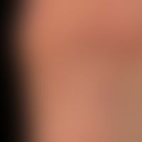Lichen planus exanthematicu... Lichen planus exanthematicus: Detailed section with circumscribed infestation of the sole of the ...