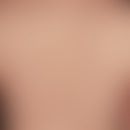 Dermatitis herpetiformis: chronisch rezidivierender Krankheitsverlauf. Besteht seit  etwa 3 Jahre...
