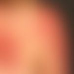 Pronounced. large-area allergic contact eczema: large, blurred (scattered edges), itchy, red, rou...