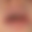 Gingivostomatitis herpetica. 3-day-old clinical picture with fever of regional lymphadenitis, pai...