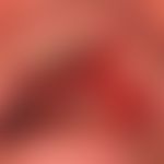 Contact allergy, contact allergic mucositis: pronounced, sharply defined contact mucositis on pro...
