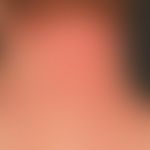 Ekzem, atopisches: disseminiertes Krankheitsbild mit chronisch stationären, unscharf begrenzten, ...