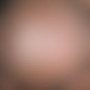 Tinea capitis superficialis: seit mehreren Monaten bestehender, langsam zentrifugal wachsender, r...