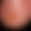 Nagelhämatom mit Splitterblutung und distaler Onycholyse..
