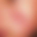 Leishmaniose, kutane (klassische Orientbeule):  mehrere Wochen nach einem Mallorca-Urlaub aufgetr...