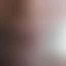 Mukokutane Leishmaniose: bei einem HIV-infizierten Patienten. Derbe, nicht schmerzhafte Schwellun...