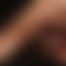Dermatitis kontaktallergische: ausgelöst durch Tragen dieses Holzschmuckes.
