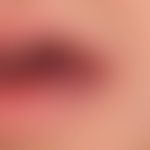 Malformations vascular (non-syndromal, mixed, capillary/venous): Congenital vascular malformation...