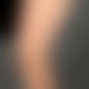 Pruritus brachioradialer: frequently occurring unpleasantly prickly itching on the extensor forea...