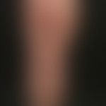 Malformations, syndromal vascular: Nevus flammeus (capillary malformation, no arterio-venous anas...
