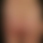 Malformations vascular (detailed picture): Nevus flammeus (capillary malformation) with soft tiss...