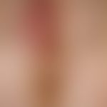 Staphylokokkenabszess der rechten großen Labie bei einem 7-jährigen Mädchen. Abb. aus Eiko E. Pet...