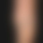 Malformation, vascular: venousmalformation with circumscribed, painless soft tissue swelling; ect...
