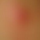 Furunculoid myiasisMyiasis: After a stay in the tropics the 25-year-old patient showed a furuncul...