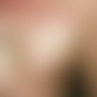 Naevus anaemicus: Etwa hand... Naevus anaemicus: Etwa handflächengroßer, unregelmäßig begrenzter, weißer, glatter Fleck. Nach Re...