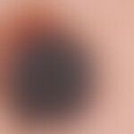 nevus, melanocytic, dysplastic. flat raised, differently colored, "restless" melanocytic nevus (h...