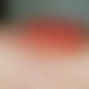 Papillomatosis cutis carcinoides. Hellrote, nackte, exophytische, blumenkohlartige Vegetationen a...