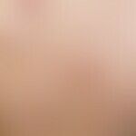 Pityriasis lichenoides et varioliformis acuta. Nach fieberhaftem Infekt akut aufgetretenes "bunte...