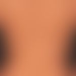 Pityriasis versicolor alba. Depigmentierungen nach abgeheilter Infektion.
