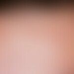 Pustulosis, sterile eosinophils, moderately itching, urticarial papules and plaques, papulovesicl...
