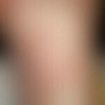 Split skin transplantation. Fig. 2 b: Skin condition 2 years after wound conditioning and free tr...
